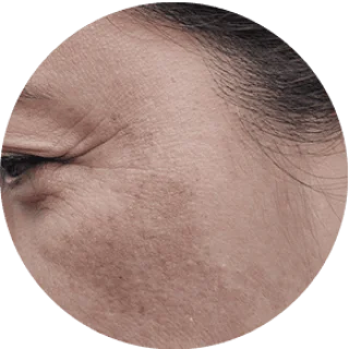 Dull Complexion